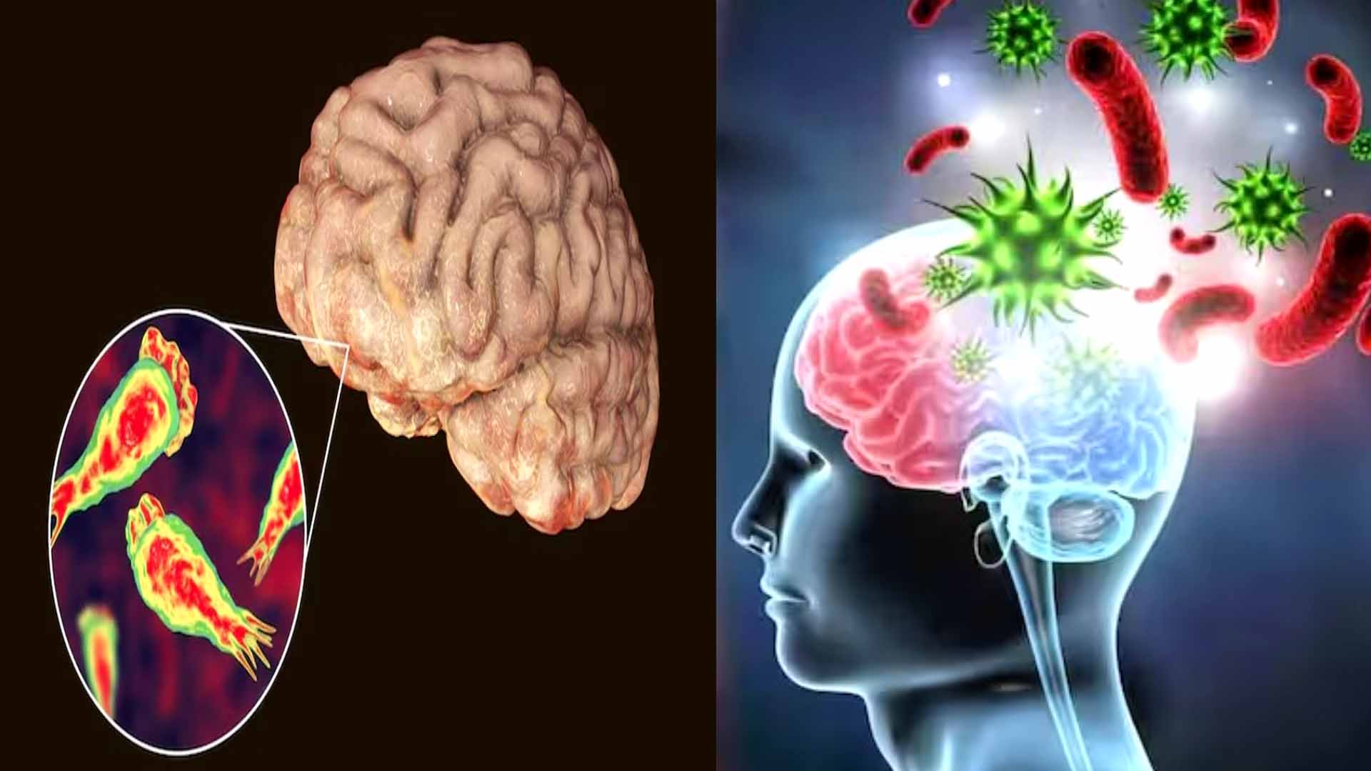 केरल में ‘दिमाग खाने वाले’ इंफेक्शन का कहर, 76 संक्रमित, 18 की मौत