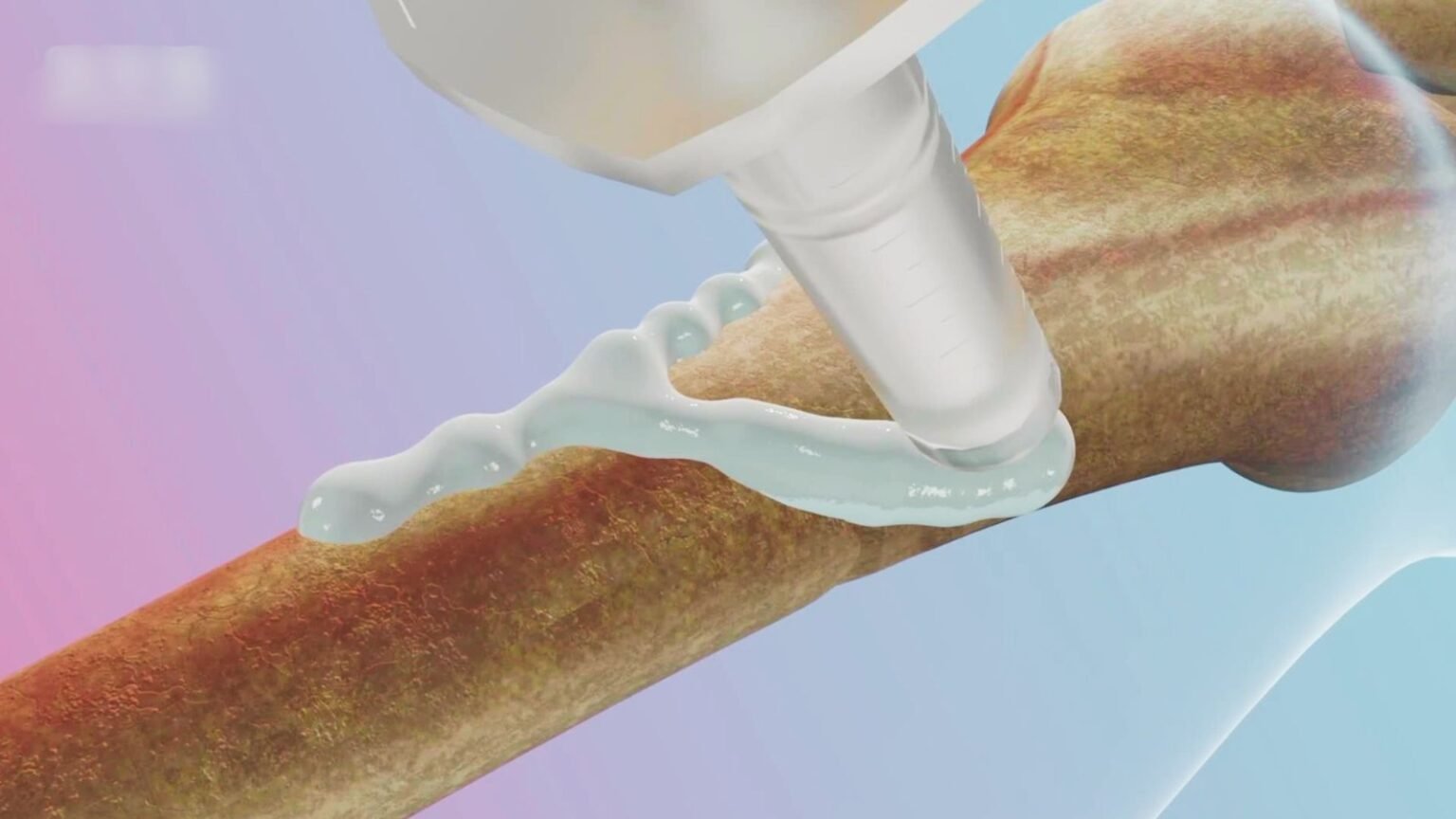 bone fevicol invents one minute fracture fix doctors stunned