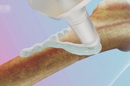 bone fevicol invents one minute fracture fix doctors stunned