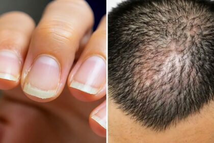 do you know what the biggest reason for hair fall and weak nails is